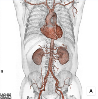 大血管CT